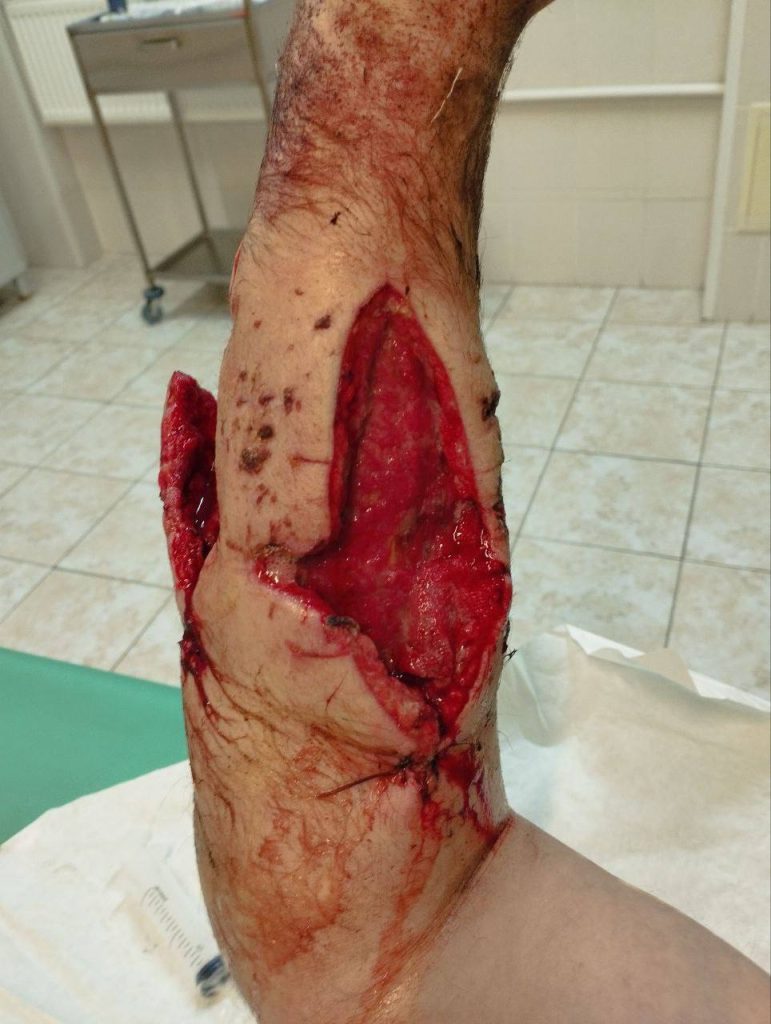 Российский боец ММА Вячеслав Дацик ранен в зоне СВО при выполнения боевой задачи🔞