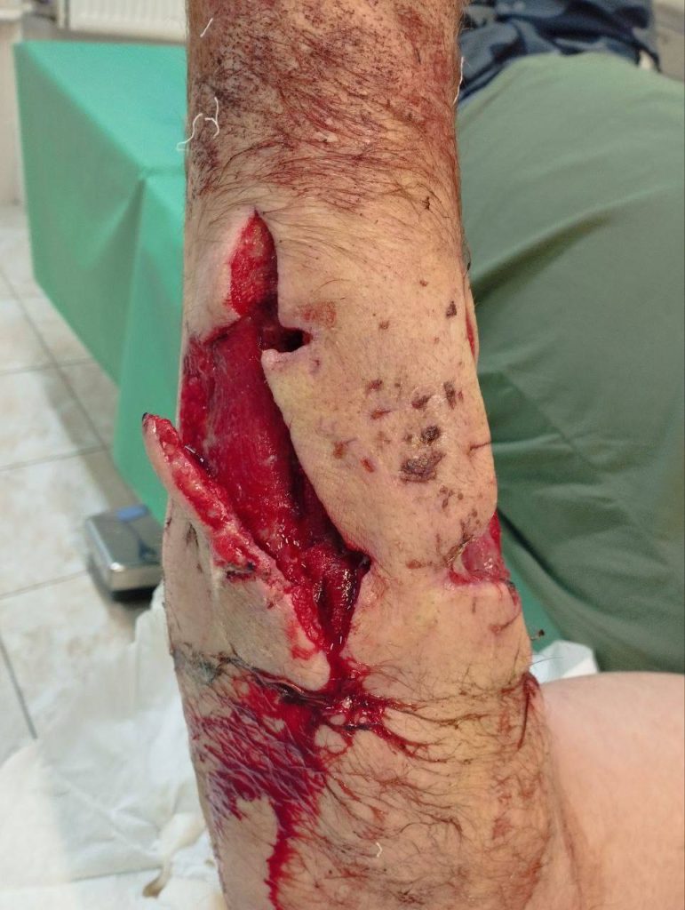 Российский боец ММА Вячеслав Дацик ранен в зоне СВО при выполнения боевой задачи🔞