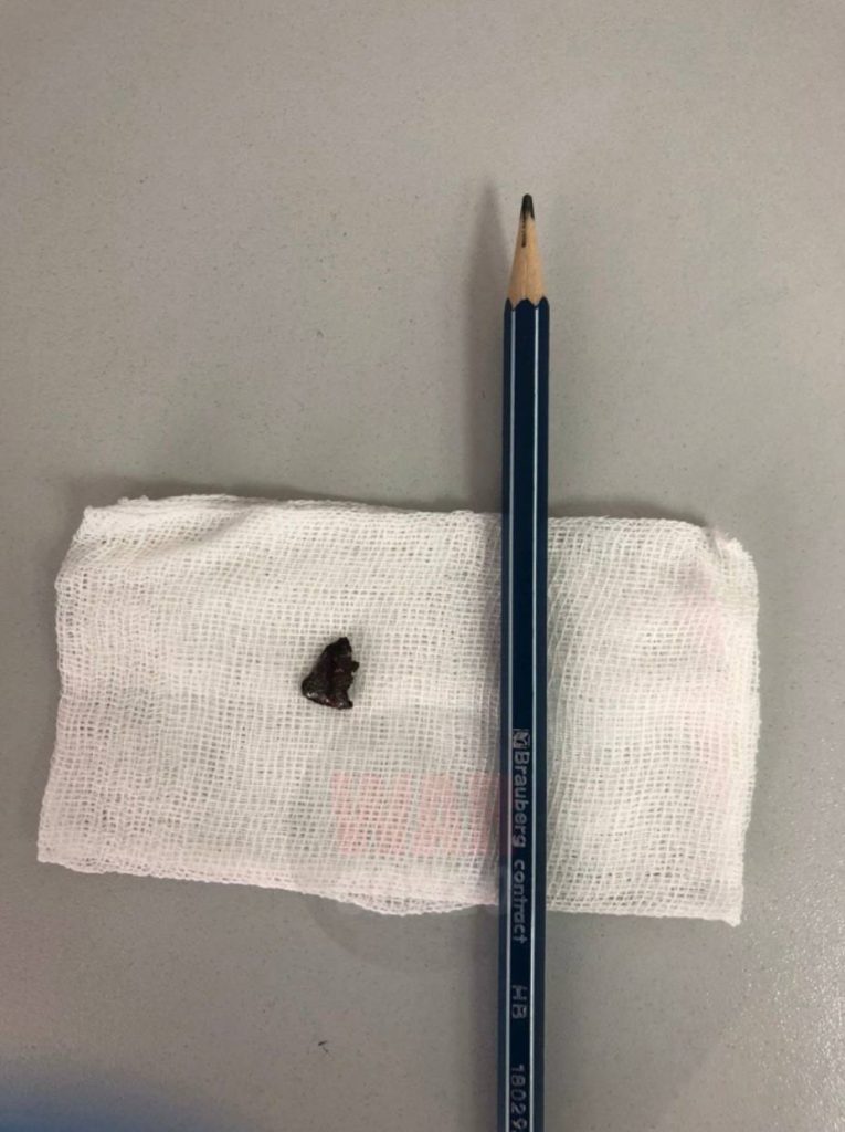 ⚡️Белгородец выжил после попадания осколка в голову⚡️