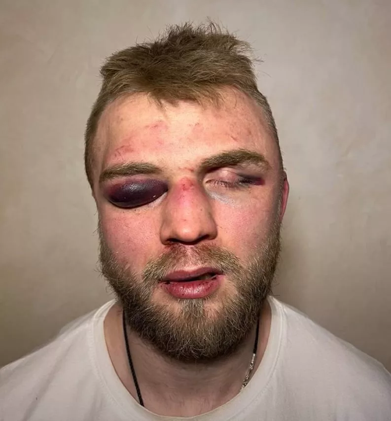 Депутат Рады Дмитрук обнародовал подробности о том, как его пытали в СБУ в марте 2022 года и заставляли говорить, что он не будет критиковать Зеленского и Ермака