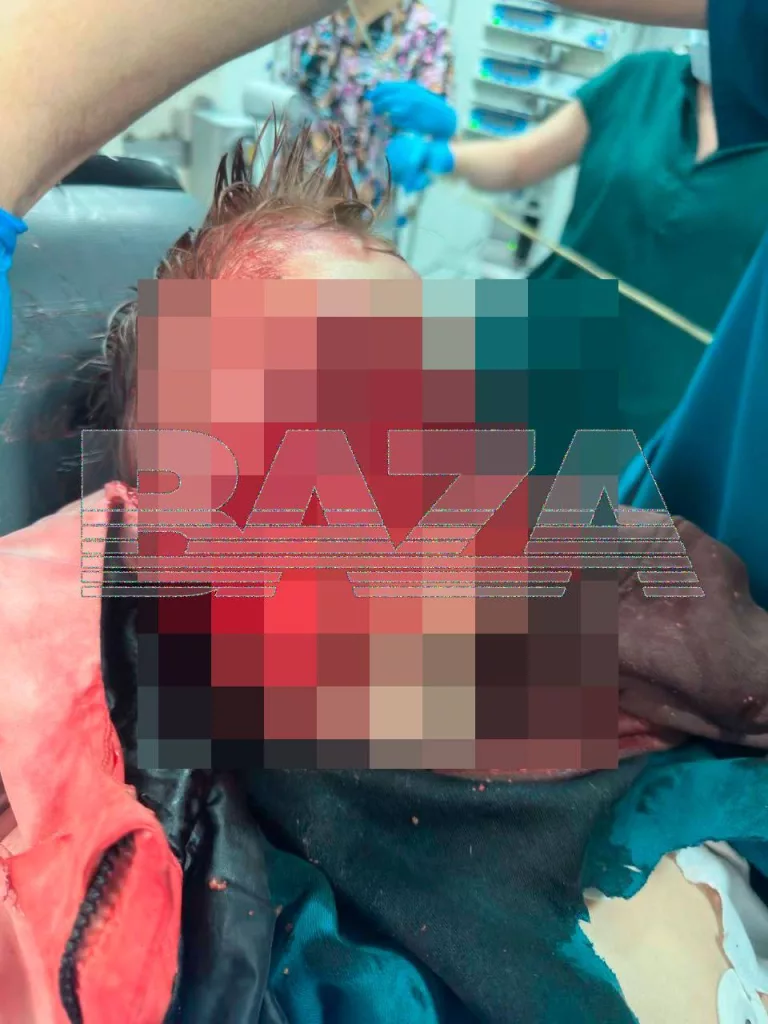 В Сочи две собаки напали на восьмилетнего мальчика, когда он шёл из школы — ребенок получил тяжелые травмы, у него порвано лицо, он находится в больнице в критическом состоянии на ИВЛ, впереди еще несколько операций