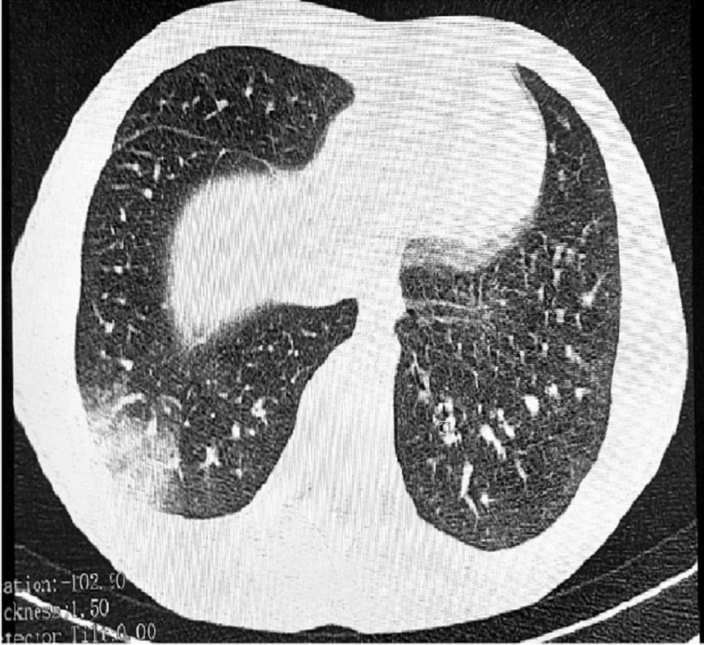 В России выявили первый случай неизлечимой болезни вейперов — EVALI или «Попкорновая болезнь»