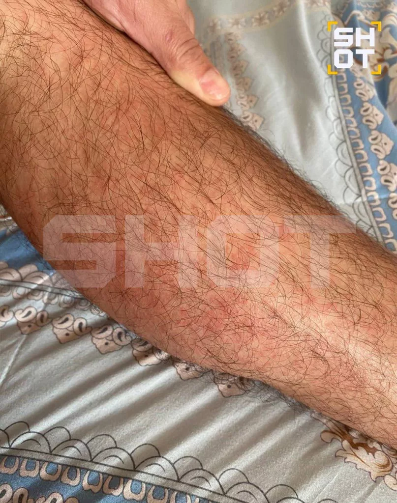 Российские туристы массово заражаются лихорадкой денге и в Таиланде