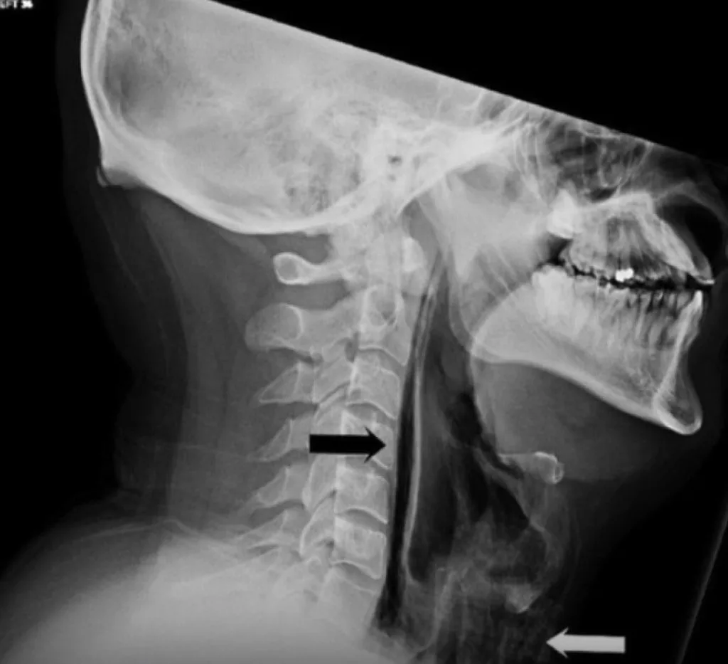 Россиянин разорвал пищевод, когда попытался сдержать чихание