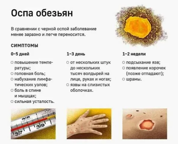 В России зафиксированы первые завозные случаи оспы обезьян, — Роспотребнадзор