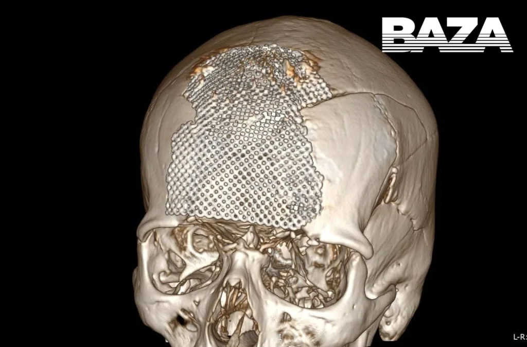 Врачи чудом спасли военного с дырой в голове: снаряд почти полностью разрушил его череп. Для операции медикам буквально пришлось воссоздать копию черепа