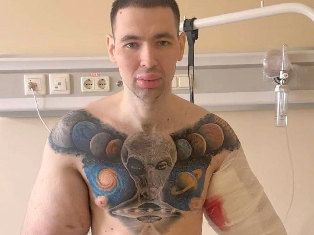 СМИ сообщают что блогеру Руки-Базуки может потребоваться ампутация конечностей0