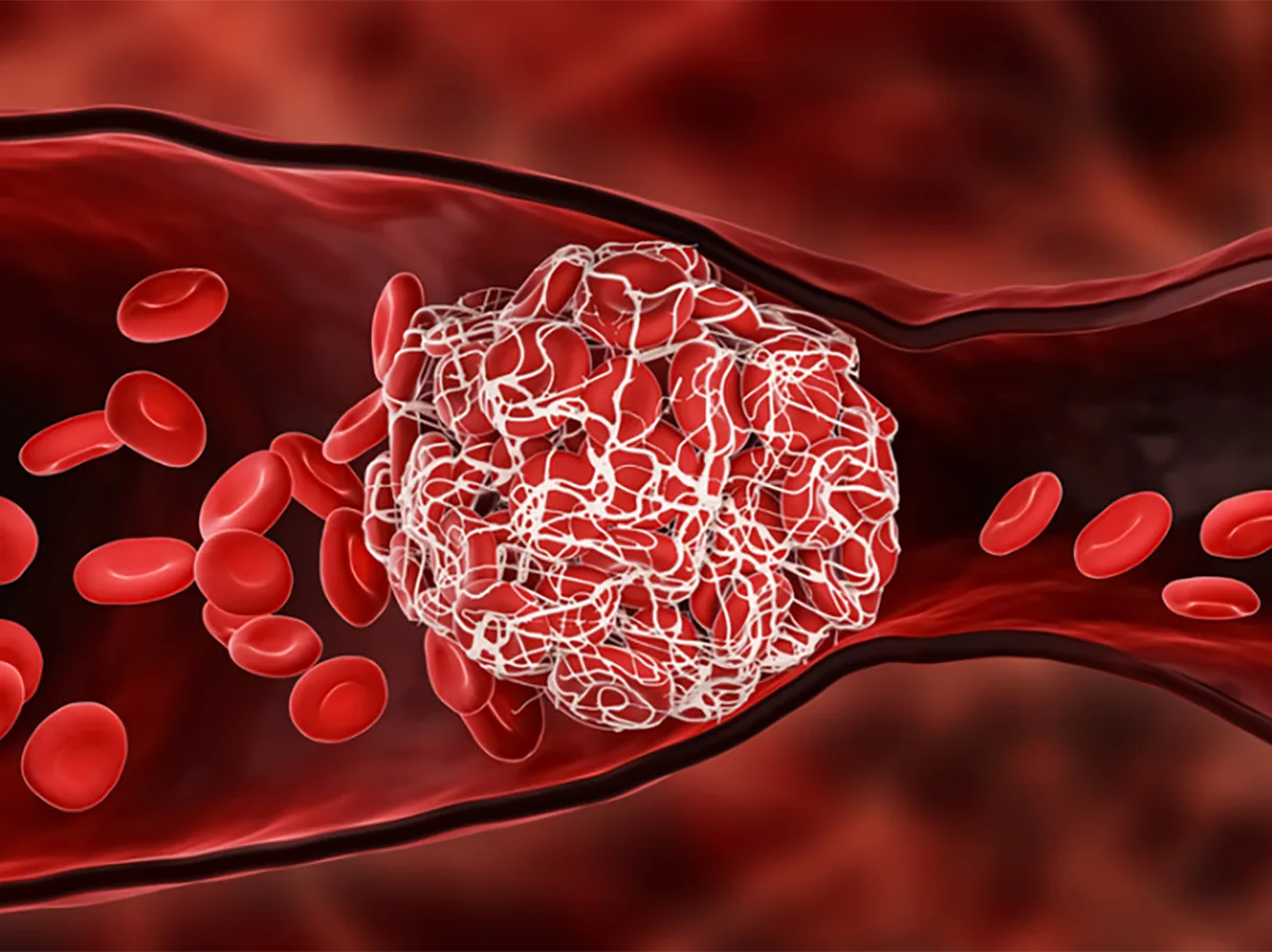 Врач рассказала, как снизить опасный холестерин, вызывающий тромбы0