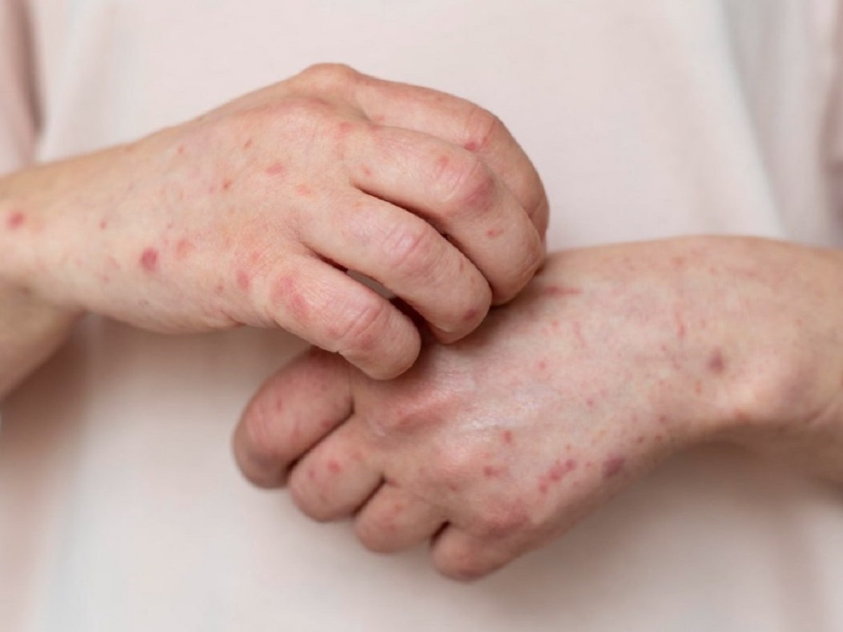 В Подмосковье госпитализированы мужчины с подозрением на заболевание оспой обезьян0